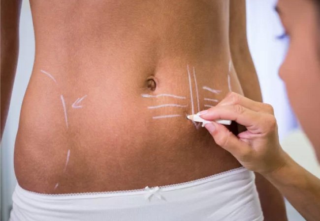 Liposuction Treatment in Gurgaon